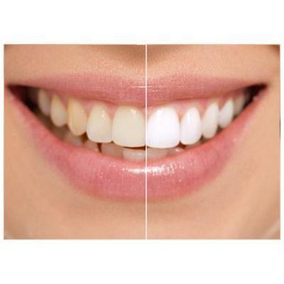 BLANCHISSEUR DE DENTS SMILE Achat / Vente soin blanchiment dents